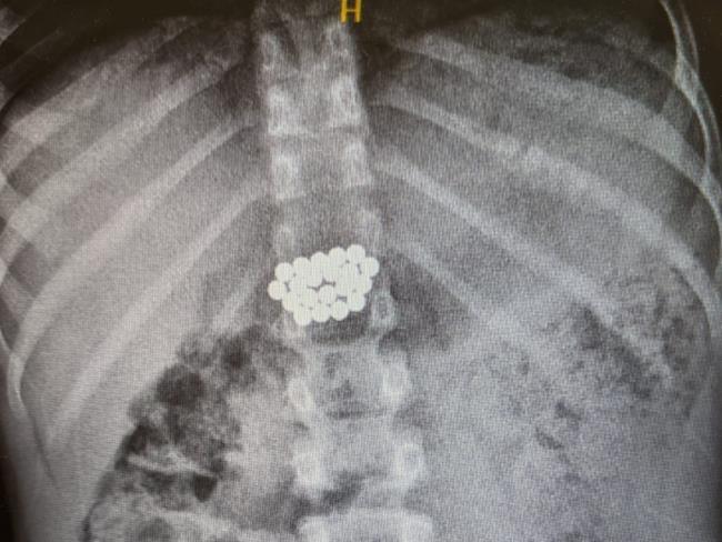 Экстренная операция в медцентре «Меир»: мальчик проглотил два десятка магнитов