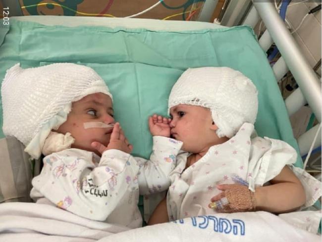 В Израиле впервые проведена операция по разделению сиамских близнецов, соединенных головами