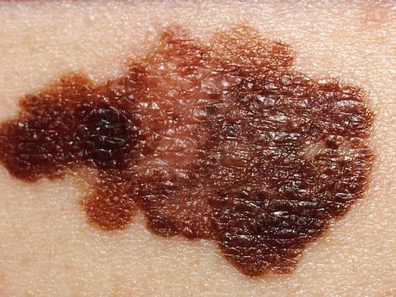 Солнце, возраст, пол… что еще увеличивает риск заболеть раком кожи?